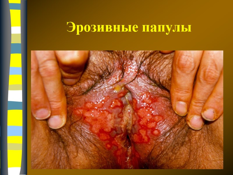 09.12.2017 Эрозивные папулы